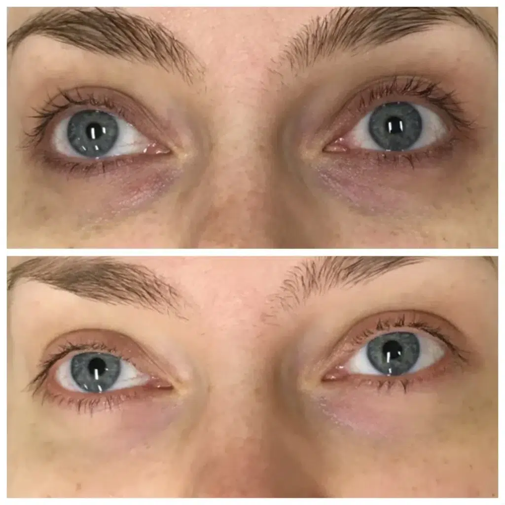 Tratament_cearcane_Juvelook_before_after_Skina_Dermatologie_Bucuresti