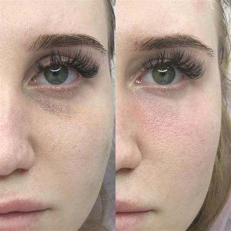 Tratament_cearcane_before_after_Skina_Dermatologie_Bucuresti