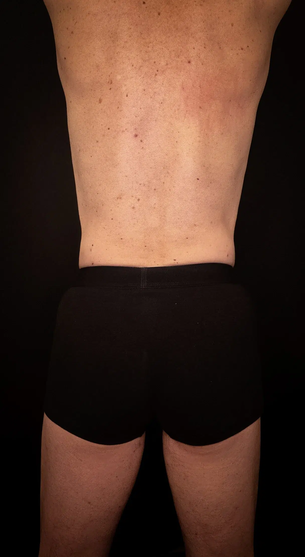 Lipo Derm flancuri after Skina Dermatologie Bucuresti