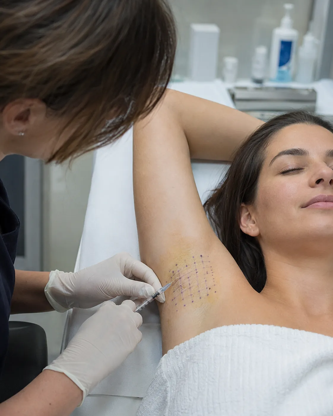 Hiperhidroză 1 Injectare cu toxină botulinică în zona axilară pentru tratamentul hiperhidrozei