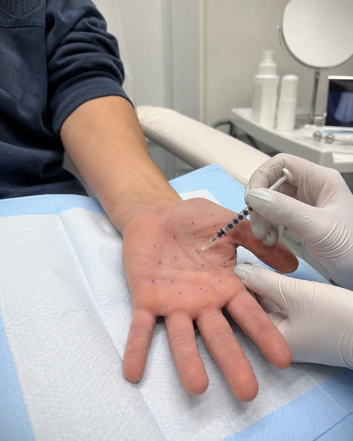 Hiperhidroză palmară 1 Tratament cu toxină botulinică pentru hiperhidroză palmară la clinica Skina din București